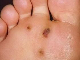 Wie man eine Plantarfarm loswerden