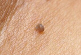 Papilloma Klinisches Bild