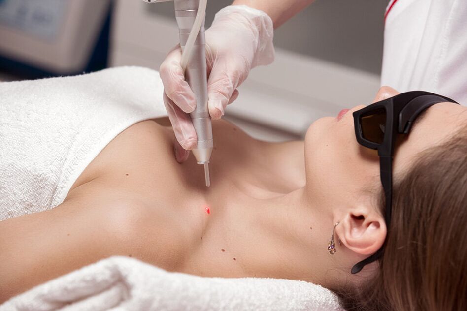 Papillome Laser