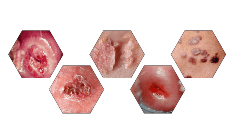 Warum sind Papillome gefährlich