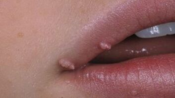 Papillome auf den Lippen.